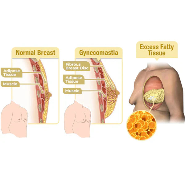 Huile chauffante pour gynécomastie au venin d'abeille GFOUK™ MenTherm