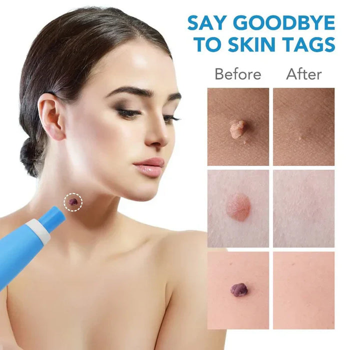 SCHMERZLOSES AUTOMATISCHES SKIN TAG ENTFERNUNGS-KIT™