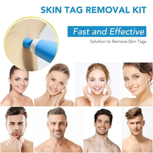 SCHMERZLOSES AUTOMATISCHES SKIN TAG ENTFERNUNGS-KIT™