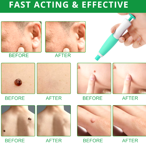 2-in-1 Painless Skin Tag, Mole, and Wart Removal Kit