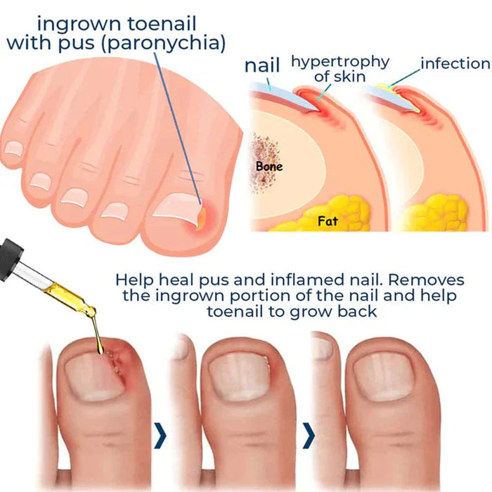 German ToenailPlus™ Anti-Paronychie-Linderungsöl